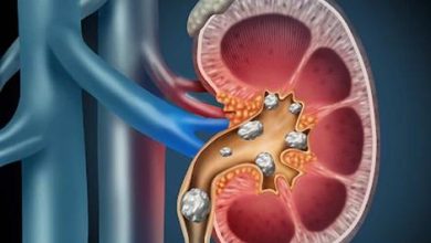 سنگ کلیه را چگونه درمان کنیم؟ 6 سنگ کلیه را چگونه درمان کنیم؟