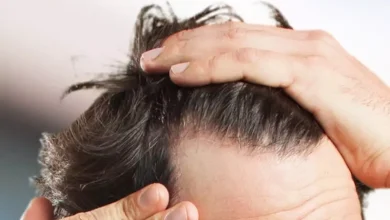 کشف جدید: دوز پایین آنتیبیوتیک هم ریزش مو را درمان میکند 5 کشف جدید: دوز پایین آنتیبیوتیک هم ریزش مو را درمان میکند