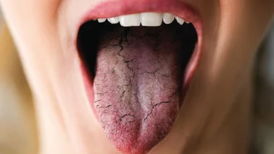 پژوهشگران چینی مکانیسم خشکی دهان را کشف کردند 3 پژوهشگران چینی مکانیسم خشکی دهان را کشف کردند