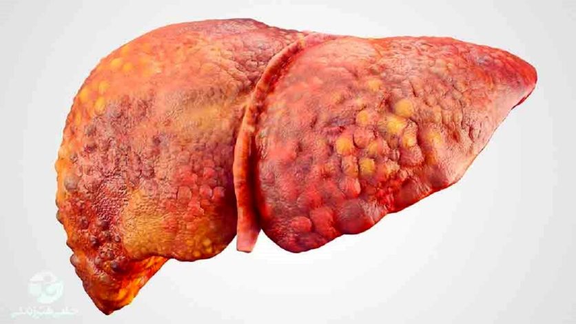 چگونه چربی کبد را کاهش دهیم؟ 1 چگونه چربی کبد را کاهش دهیم؟