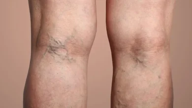 علائم اولیه واریس را بشناسید