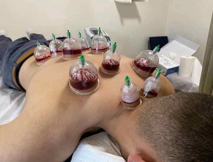 با فواید درمانی حجامت بیش‌تر آشنا شوید
