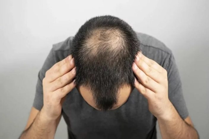 کشف تصادفی یک درمان ارزان برای طاسی سر 1 کشف تصادفی یک درمان ارزان قیمت طاسی سر