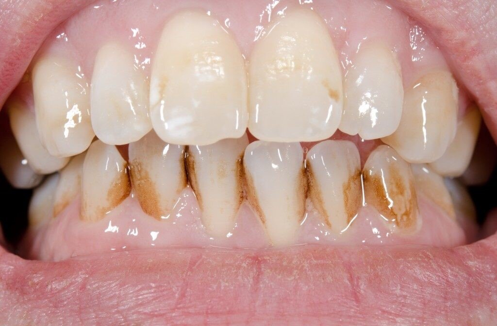 ارتباط رنگ دندان و سلامتی چیست؟