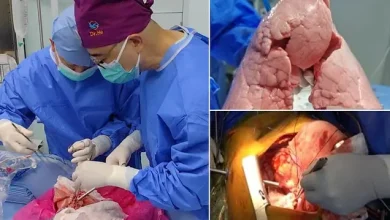 برای اولین بار در جهان: پیوند ریه خوک به انسان 2 برای اولین بار در جهان: پیوند ریه خوک به انسان