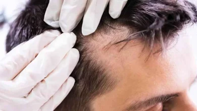 شیراز پایتخت کاشت موی کشور؛ در کلینیک‌های کاشت ‌موی شیراز چه می‌گذرد؟