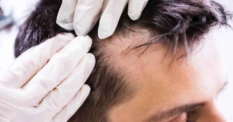 شیراز پایتخت کاشت موی کشور؛ در کلینیکهای کاشت موی شیراز چه میگذرد؟ 1 شیراز پایتخت کاشت موی کشور؛ در کلینیکهای کاشت موی شیراز چه میگذرد؟