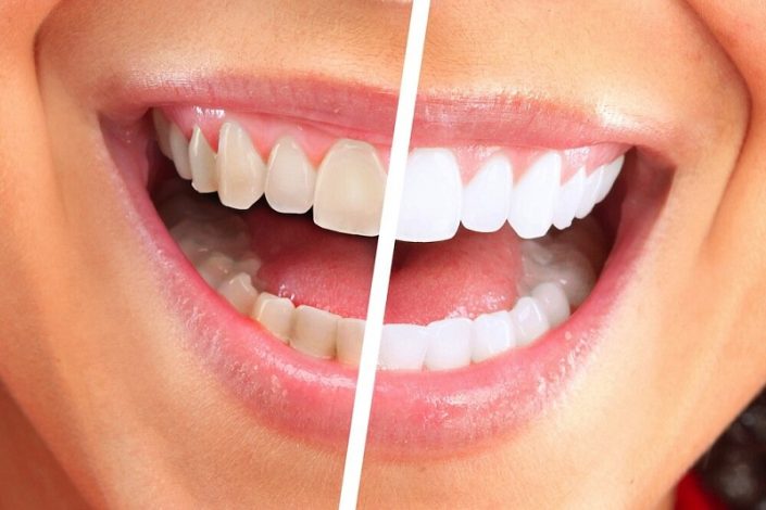 ارتباط رنگ دندان و سلامتی چیست؟ 1 ارتباط رنگ دندان و سلامتی چیست؟