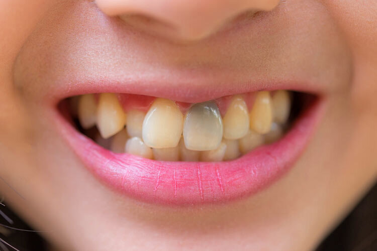 ارتباط رنگ دندان و سلامتی چیست؟ 2 ارتباط رنگ دندان و سلامتی چیست؟