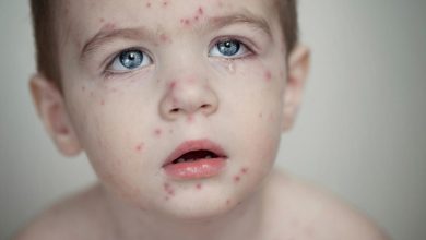 زنگ خطر سرخک در شمال کشور: ثبت 29 مورد ابتلا در بابل! 5 زنگ خطر سرخک در شمال کشور