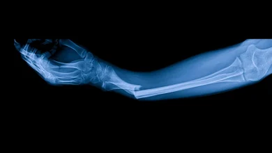 فناوری جدید چسب استخوانی که شکستگی‌ها را در چند دقیقه بهبود می‌بخشد