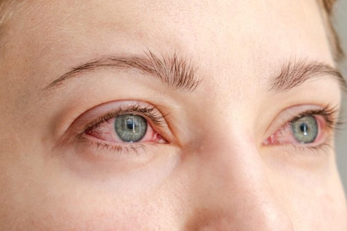 چند راهکار ساده برای مقابله با قرمزی و خارش چشم در فصل پاییز