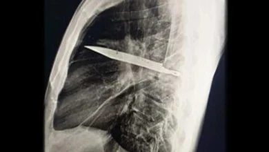 مردی که ۸ سال با این چاقو در بدنش زندگی میکرد! 7 مردی که ۸ سال با این چاقو در بدنش زندگی میکرد!