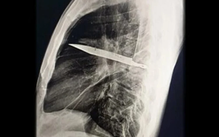 مردی که ۸ سال با این چاقو در بدنش زندگی میکرد! 1 مردی که ۸ سال با این چاقو در بدنش زندگی میکرد!