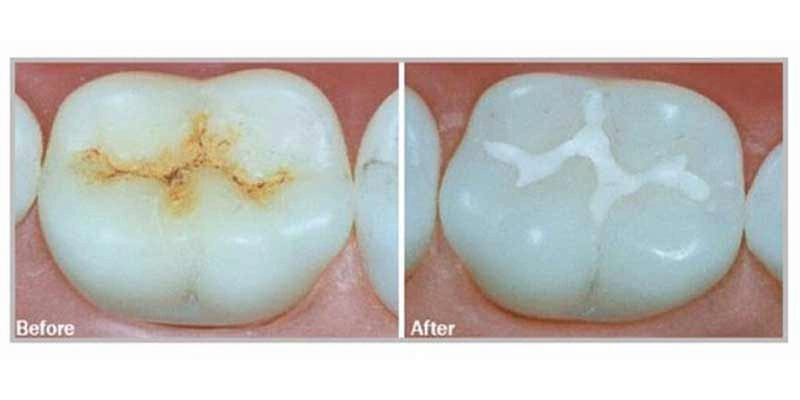 با این روش از پوسیدگی دندان کودک خود پیشگیری کنید 2 با این روش از پوسیدگی دندان کودک خود پیشگیری کنید