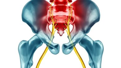 تفاوت سیاتیک و گرفتگی عضلات؛ خطرات روشهای غیرعلمی درمان 5 تفاوت سیاتیک و گرفتگی عضلات؛ خطرات روشهای غیرعلمی درمان