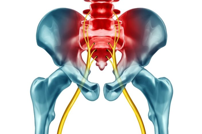 تفاوت سیاتیک و گرفتگی عضلات؛ خطرات روشهای غیرعلمی درمان 1 تفاوت سیاتیک و گرفتگی عضلات؛ خطرات روشهای غیرعلمی درمان