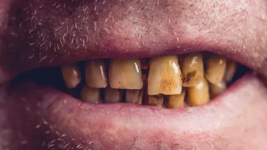 دندان افراد سیگاری ۴ برابر دیگران خراب میشود 10 دندان افراد سیگاری ۴ برابر دیگران خراب میشود