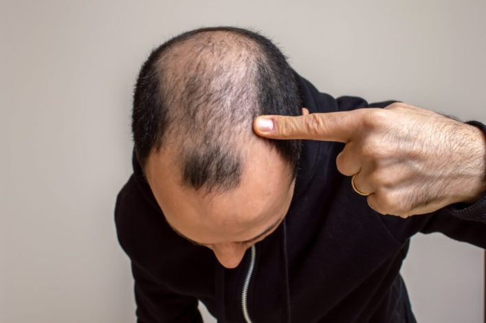 مصرف این نوشیدنی باعث ریزش مو میشود 1 مصرف این نوشیدنی باعث ریزش مو میشود
