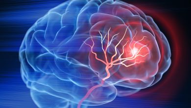 درمان آسیب مغزی ناشی از سکته با تزریق سلول‌های بنیادی