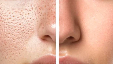 با منافذ باز پوست چه کنیم؟ 2 با منافذ باز پوست چه کنیم؟