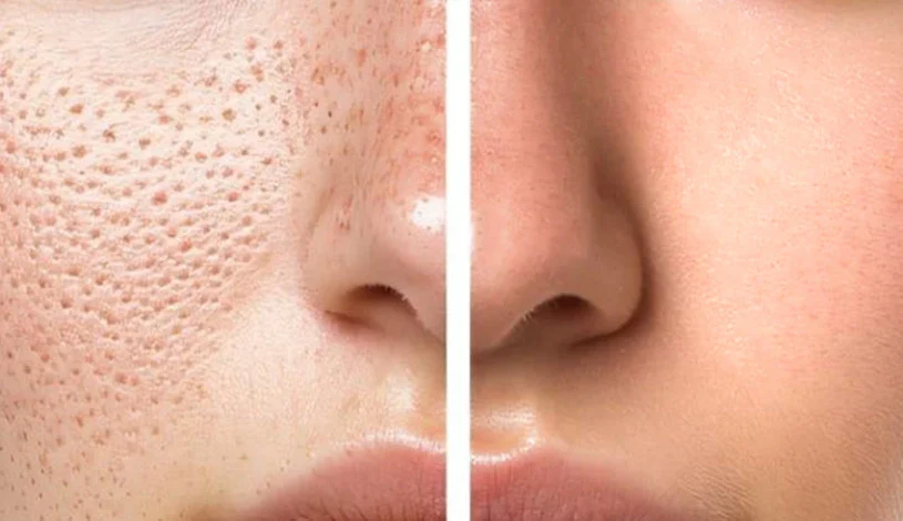 با منافذ باز پوست چه کنیم؟